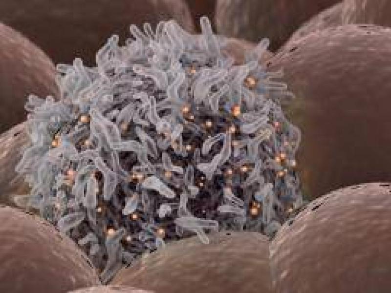 Adenokarsinom tipleri, belirtileri ve nedenleri