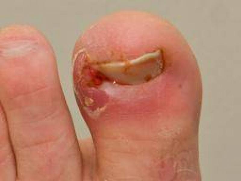Tırnak batmasının tedavisi, nedenleri ve belirtileri