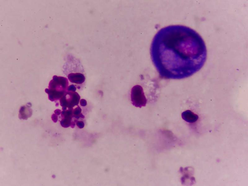 Çocuklarda ve yetişkinlerde displazi