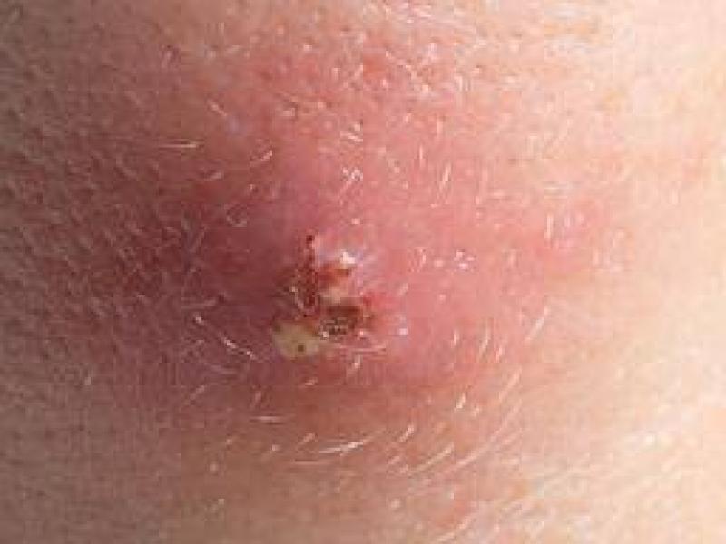 Furuncles ve karbuncles belirtileri, nedenleri ve tedavisi