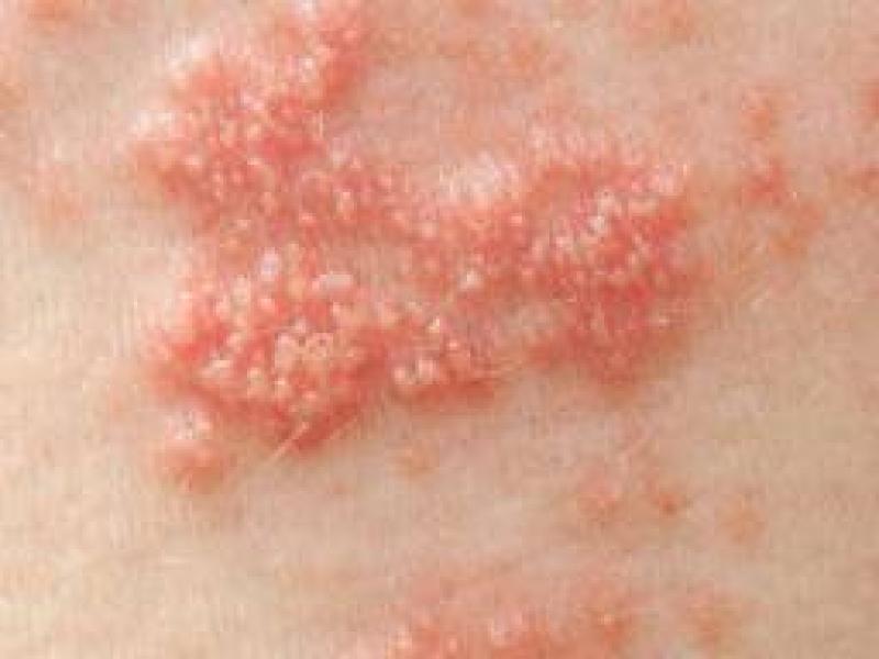 Postherpetik nevralji tedavisi, belirtileri ve nedenleri