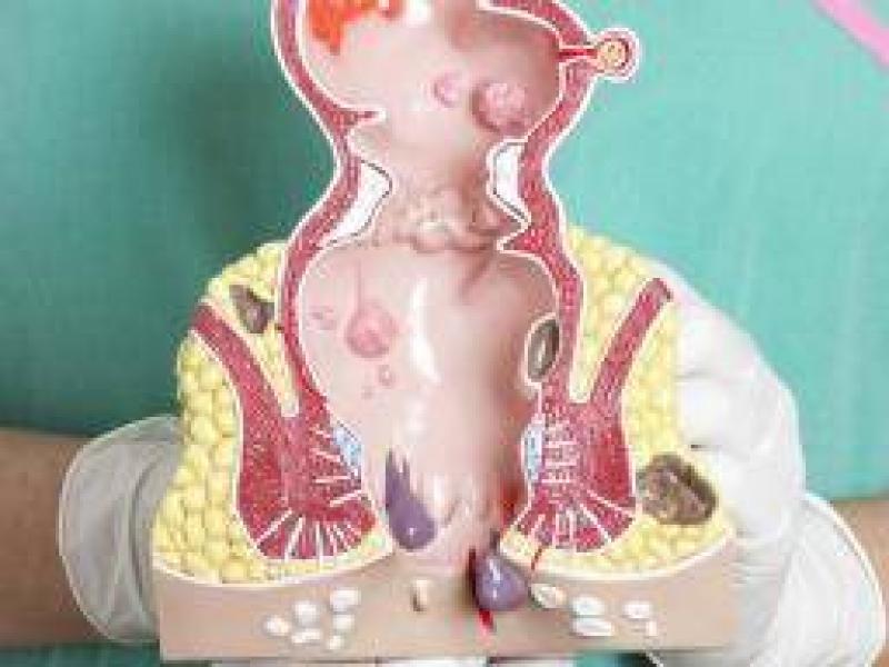 Rektal prolapsus (makat sarkması) nedenleri, belirtileri ve tedavileri