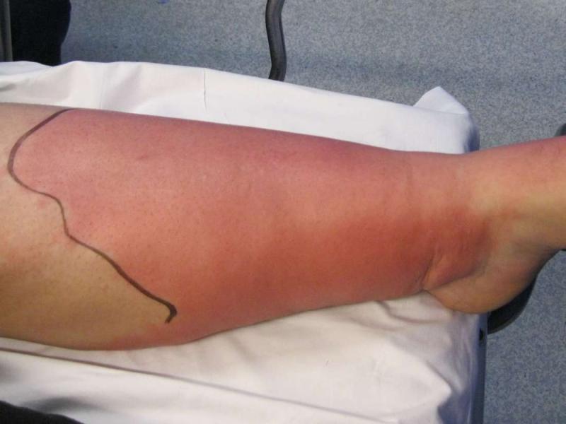 Selülitin belirtileri ve tedavisi