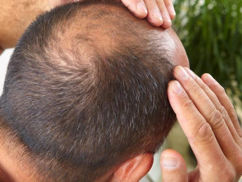 Dihidrotestosteronun kellikteki rolü nedir?