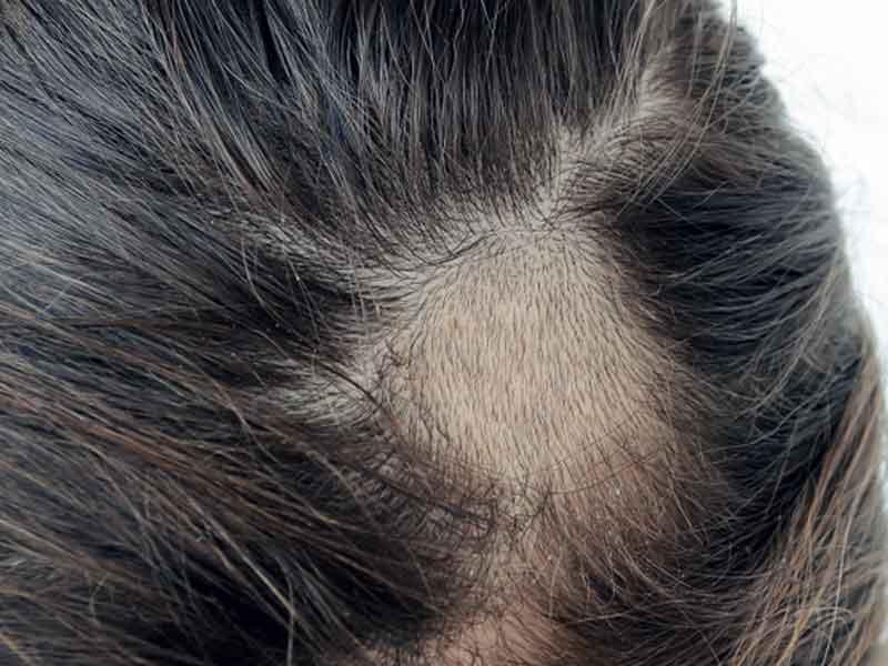 Saçkıran tedavisi ve belirtileri