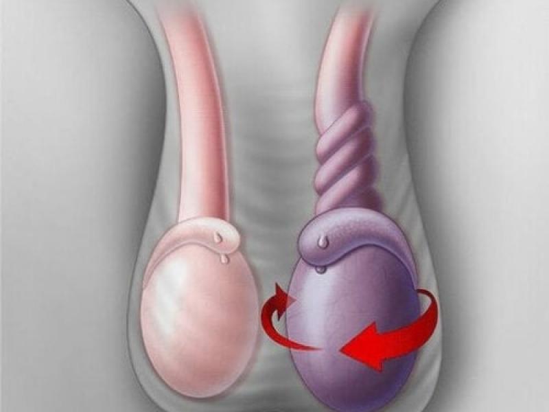Testis torsiyonu nedenleri, belirtileri ve tedavisi