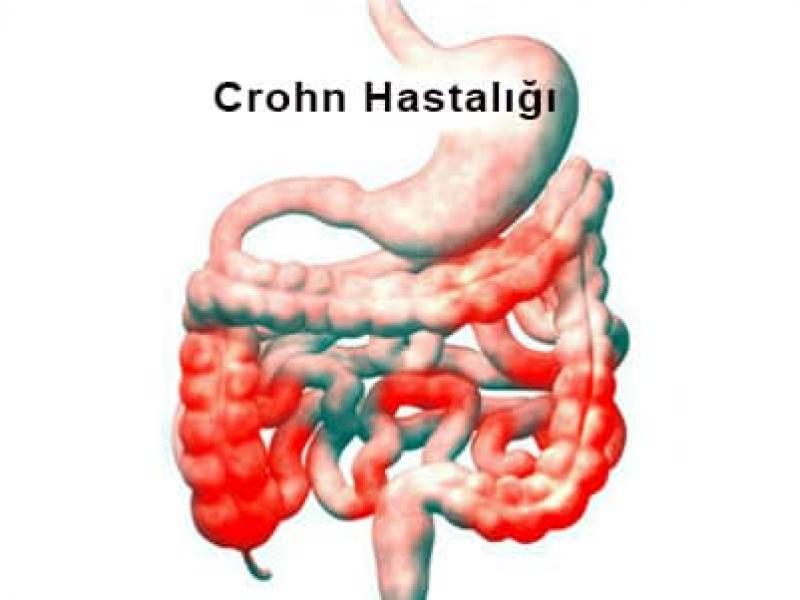 Crohn hastalığının aşamaları belirtileri, komplikasyonları ve tedavisi