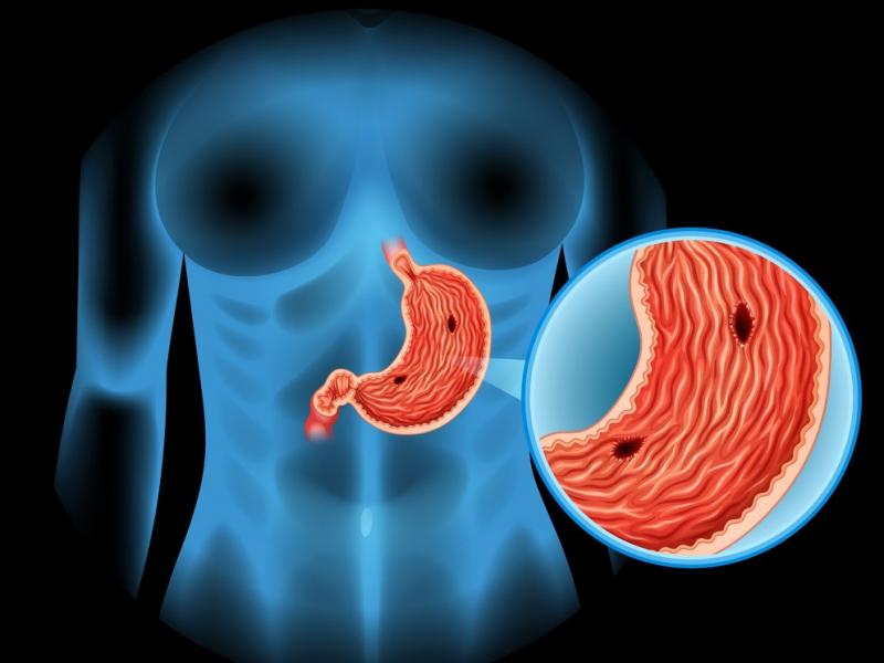 Mide ülseri nedenleri, belirtileri ve tedavisi