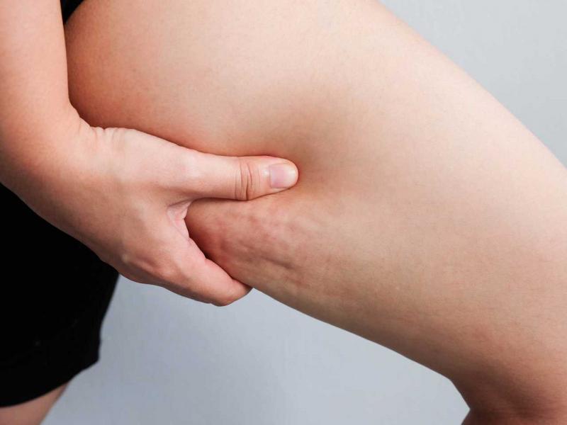 Selülit nedenleri, tedavisi ve önlenmesi